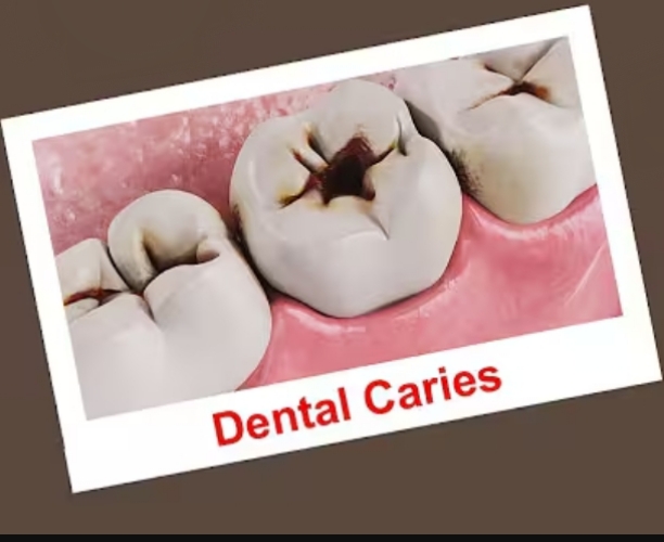 Dental-Caries